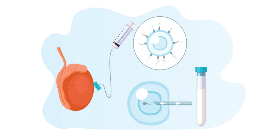 Micro-TESE Procedure
