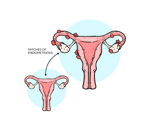 PCOD Stimulation Protocol